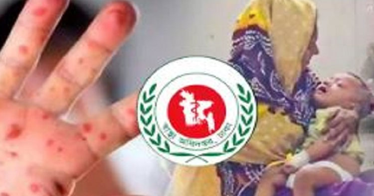হাম ও উপসর্গে একদিনে ৫ মৃত্যু, নতুন রোগী ১ হাজার ২০
