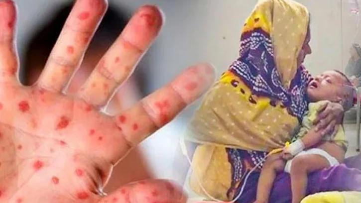 ২৪ ঘণ্টায় হাম ও উপসর্গে ৭ জনের মৃত্যু