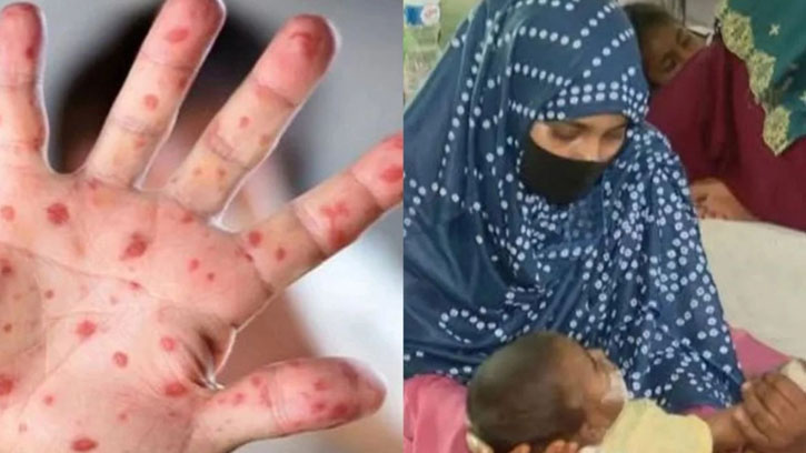 হামের উপসর্গে আরও ৪ শিশুর মৃত্যু