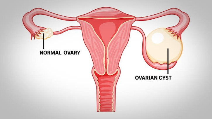 PCOS নিয়ন্ত্রণে রাখার সহজ ও প্রাকৃতিক পদ্ধতি