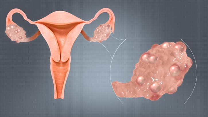 PCOS: ভুল ধারণায় আতঙ্ক নয়, সচেতনতাই মূল