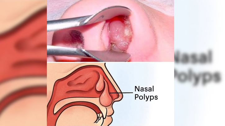 নাকের পলিপাস: উপসর্গ ও চিকিৎসা পদ্ধতি